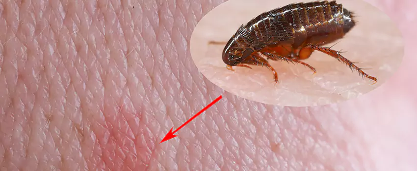 Flea Control for Humans Lakewood, CA